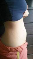 Tummy tuck or liposuction after pregnancy photo