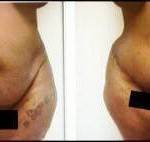 Tummy tuck pictures before and after (1)