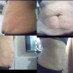 Tummy tuck pictures before and after (12)
