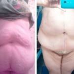 Tummy tuck pictures before and after (13)