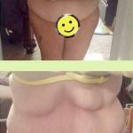 Tummy tuck pictures before and after (14)