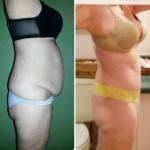 Tummy tuck pictures before and after (15)