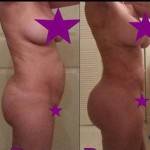 Tummy tuck pictures before and after (17)