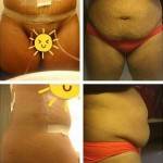 Tummy tuck pictures before and after (18)