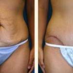 Tummy tuck pictures before and after (19)