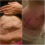 Tummy tuck pictures before and after (20)