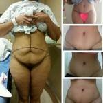 Tummy tuck pictures before and after (21)