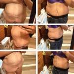 Tummy tuck pictures before and after (22)