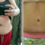 Tummy tuck pictures before and after (23)