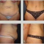 Tummy tuck pictures before and after (25)