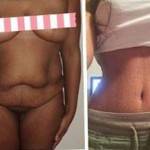 Tummy tuck pictures before and after (5)