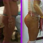 Tummy tuck pictures before and after (6)