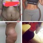 Tummy tuck pictures before and after (7)