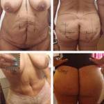 Tummy tuck pictures before and after (8)