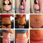 Tummy tuck pictures before and after (9)