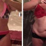 Tummy tuck pictures before and after best photos