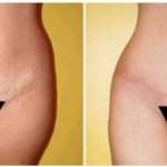 Tummy tuck pictures before and after best surgeons
