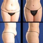 Tummy tuck pictures before and after floating belly