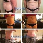 Tummy tuck pictures before and after gallery