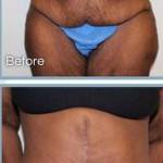 Tummy tuck pictures before and after gallery of patients