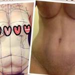 Tummy tuck pictures before and after images