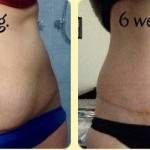 Tummy tuck pictures before and after operation