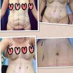 Tummy tuck pictures before and after photos