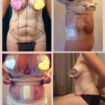 Tummy tuck pictures before and after plastic surgery