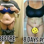 Tummy tuck pictures before and after surgery