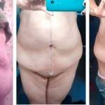 Tummy tuck pictures before and after swelling