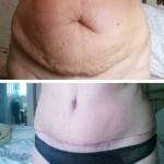 Tummy tuck pictures before and after swelling after surgery