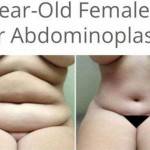 Tummy tuck pictures top surgeons before and after