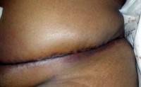 Tummy tuck plastic surgery scar photo