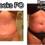 Tummy tuck procedure pictures before and after