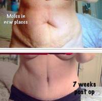 Tummy tuck procedure results before and after