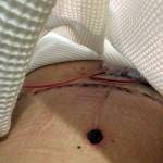 Tummy tuck procedure scars photos