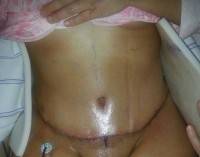 Tummy tuck recovery time off work image