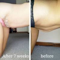 Tummy tuck results before and after images