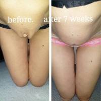 Tummy tuck results before and after photos