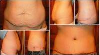 Tummy tuck results before and after pictures