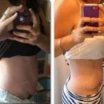 Tummy tuck scar pictures before and after