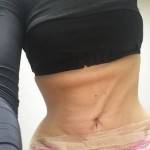 Tummy tuck scar stripas after weight loss pictures