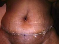 Tummy tuck scar with hysterectomy