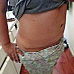 Tummy tuck scars photos after procedure