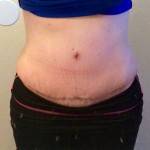 Tummy tuck scars photos after recovery