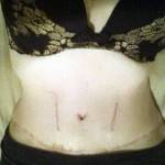 Tummy tuck scars photos image of patients