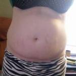 Tummy tuck scars photos pictures