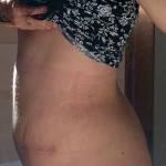 Tummy tuck scars photos pictures after