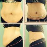 Tummy tuck scars pictures before and after