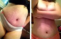 Tummy tuck sugery what to expect